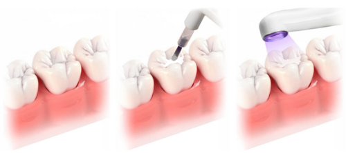 lakowanie zębów krok po kroku
