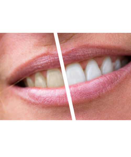 wybielanie martwego zęba