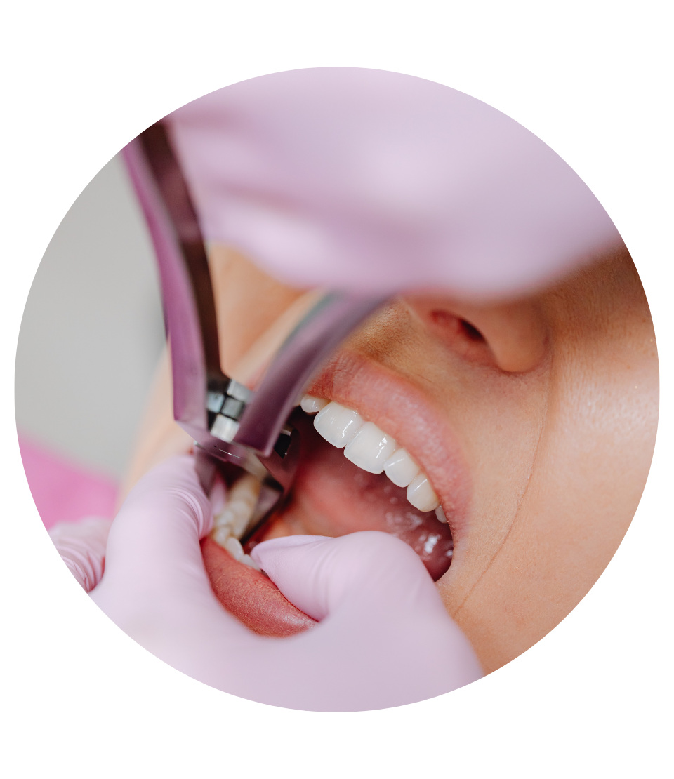 ekstrakcja zęba kiedy się wykonuje